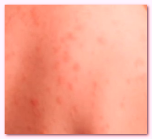 HIV rash images