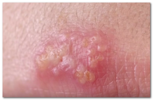 HIV rash pictures