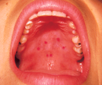 Rash On Roof Of Mouth 33