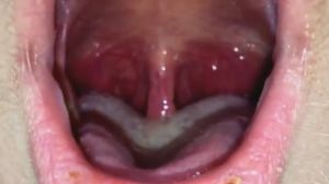 Swelling Inside The Throat 88