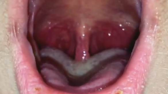 Muscle In Throat 6