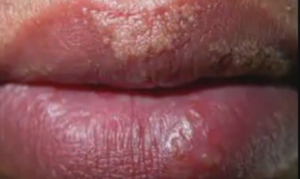 fordyce spots on lips photos