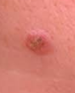 precancerous mole