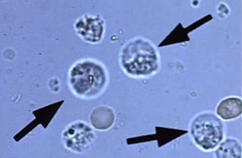 What can cause white blood cells to be in urine?