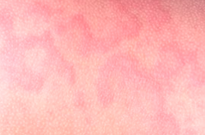 hay fever rash images