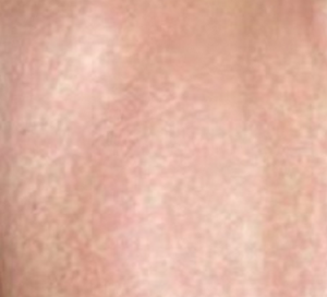 lamictal rash