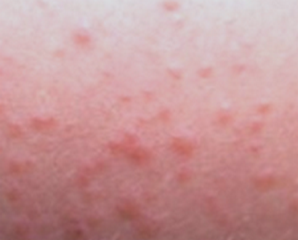 lamictal rash start