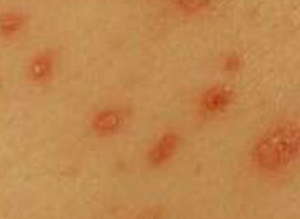 lamictal rash photo