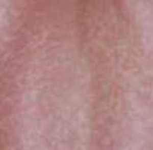 lamictal rash picture