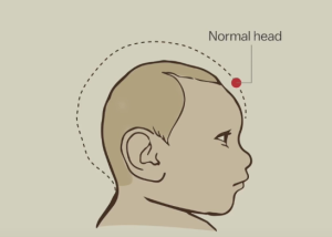 microcephaly pictures