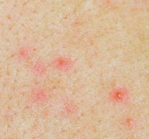 symptoms of zika rash