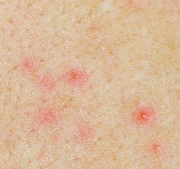 rashes caused by virus