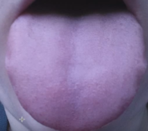 scalloped tongue images