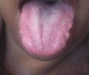 scalloped tongue pictures