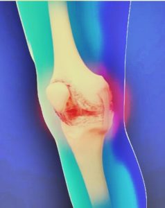 Knee Pain image