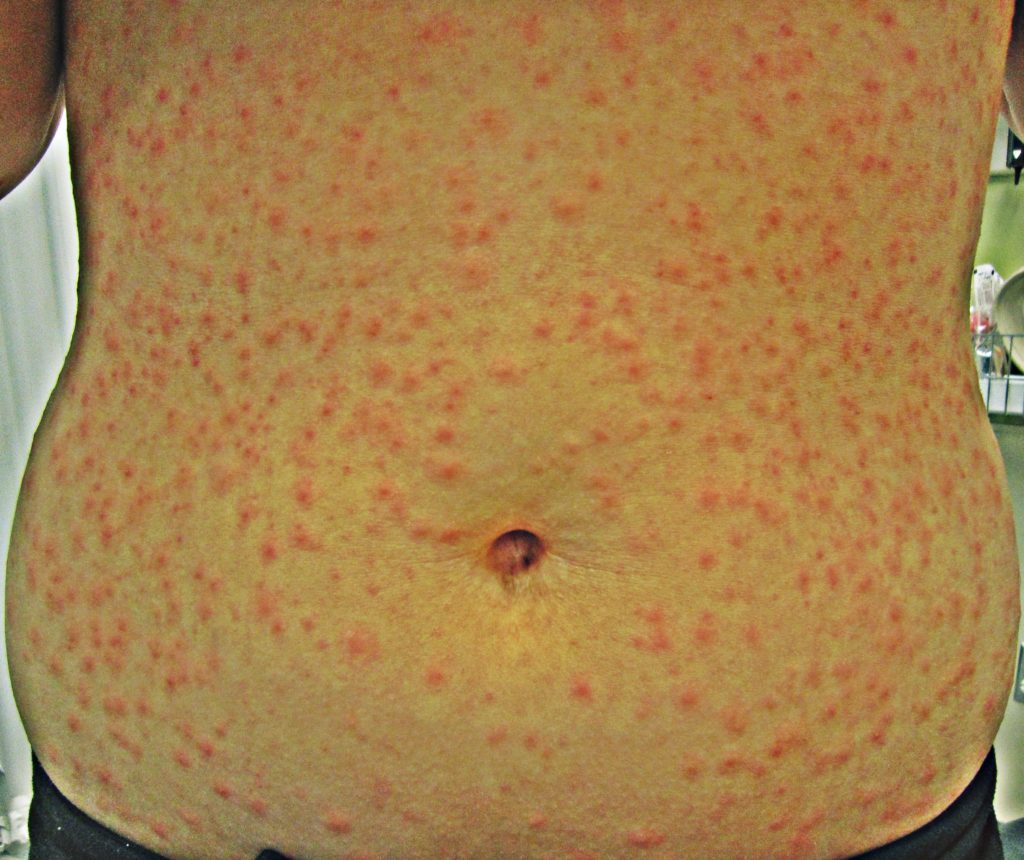 Hot Tub Rash Pictures Treatment Symptoms Causes Health Momma