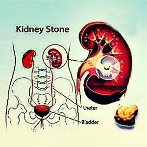 kidney-pain-after-drinking-alcohol-images