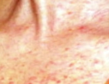 can amoxicillin cause skin rash